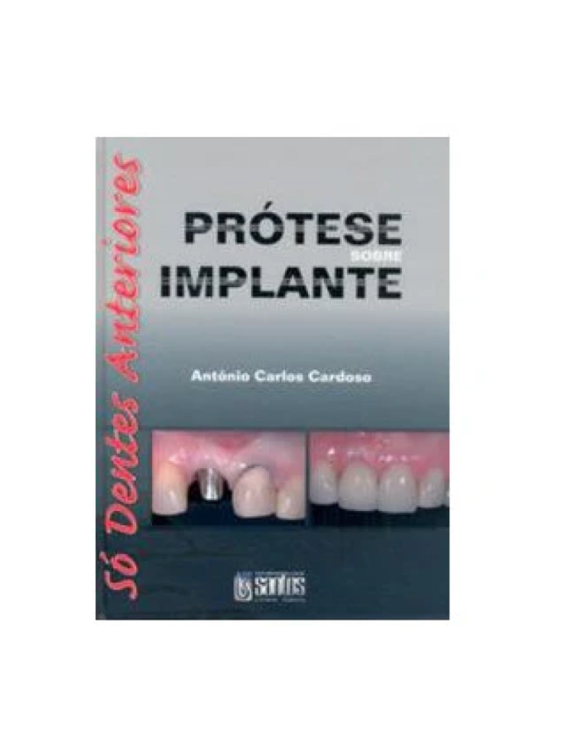 Santos - Livro, Prótese Sobre Implante Só Dentes Anteriores 1/08